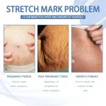 Stretch Marks Removal Cream Light Lines Postpartum Obesity Pregnancy Powerful Fast Absorption - Imagine 2